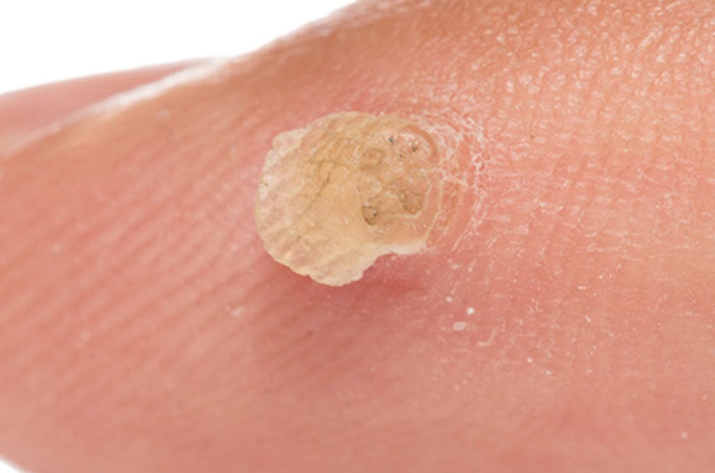 wart on finger