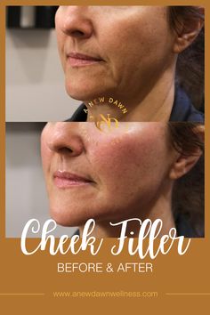 Cheek Filler Before & After from A New Dawn Wellness Center in Scottsdale, AZ