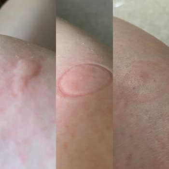Reviewer's progression shot of a bug bite before and after using the product showing the swelling has gone down