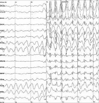 Elettroencefalogramma epilessia